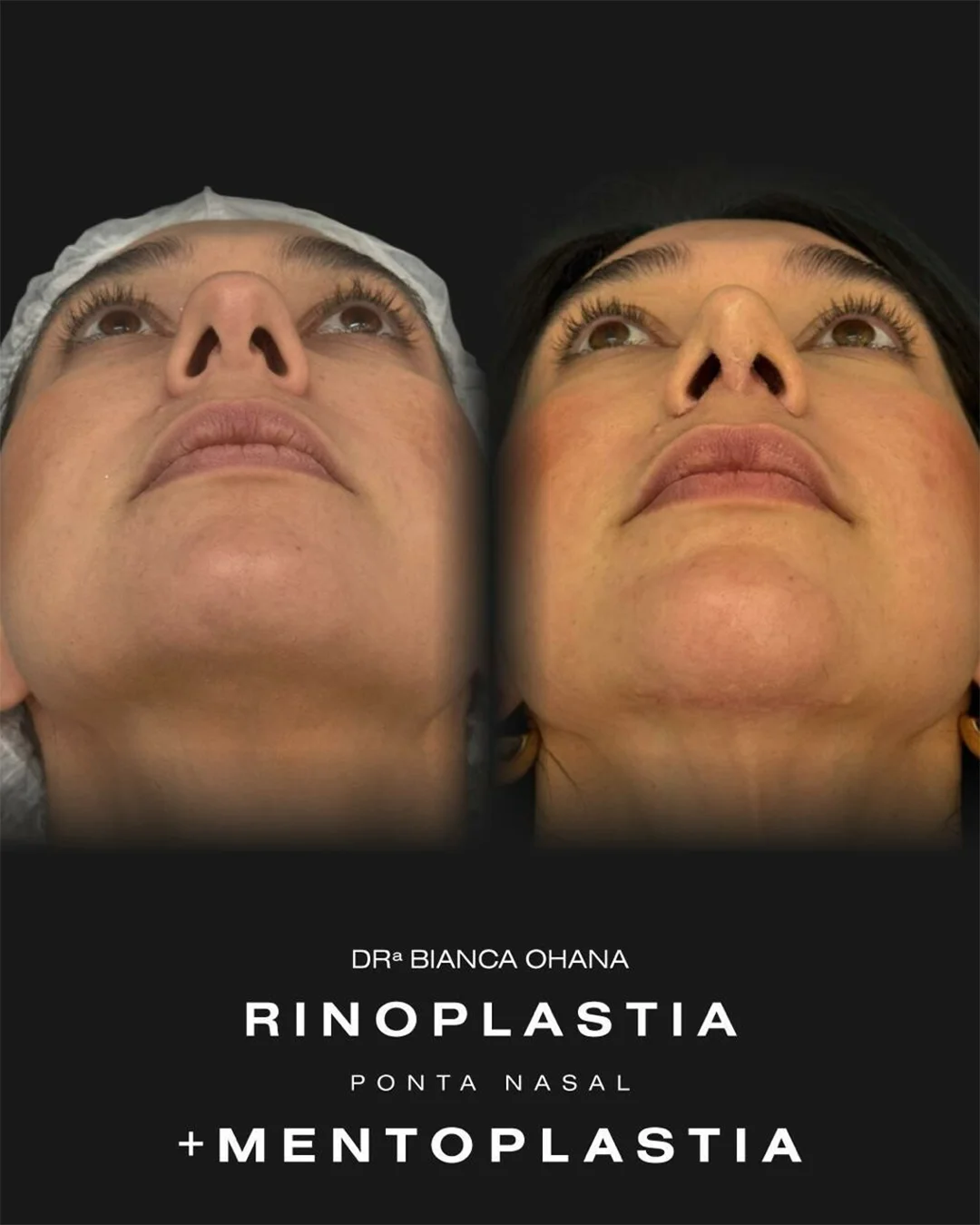 Material visual de rinoplastia usado pela Dra. Bianca Ohana