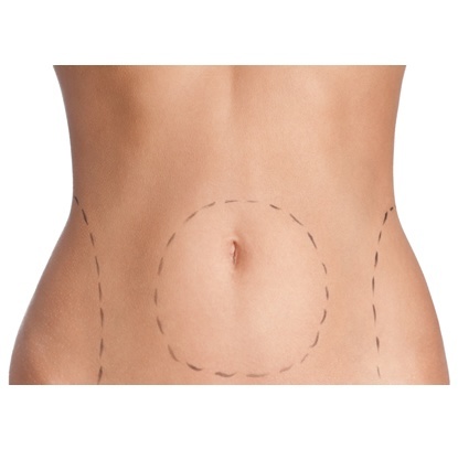 Imagem ilustrativa de lipoaspiração e lipoescultura