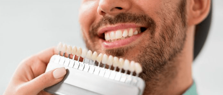 Escala de cor dental durante planejamento estético