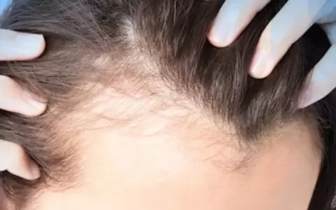 Conteúdo dermatológico sobre alopecia