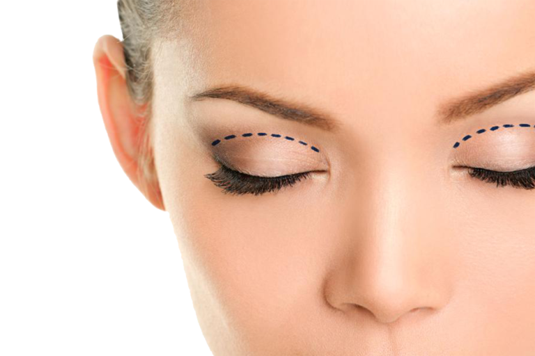 Blefaroplastia