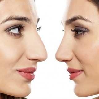 Rinoplastia