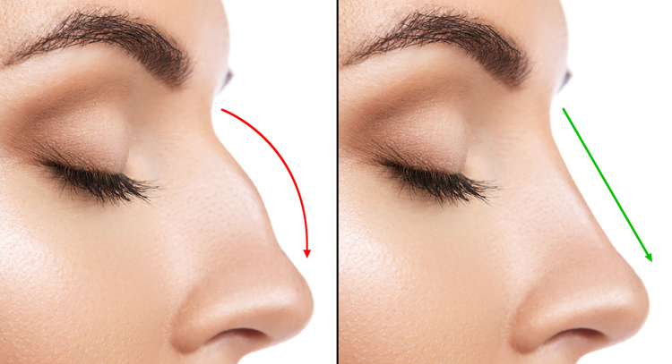 Imagem institucional sobre rinoplastia