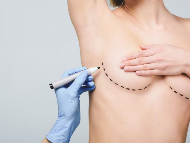 Imagem institucional sobre mamoplastia