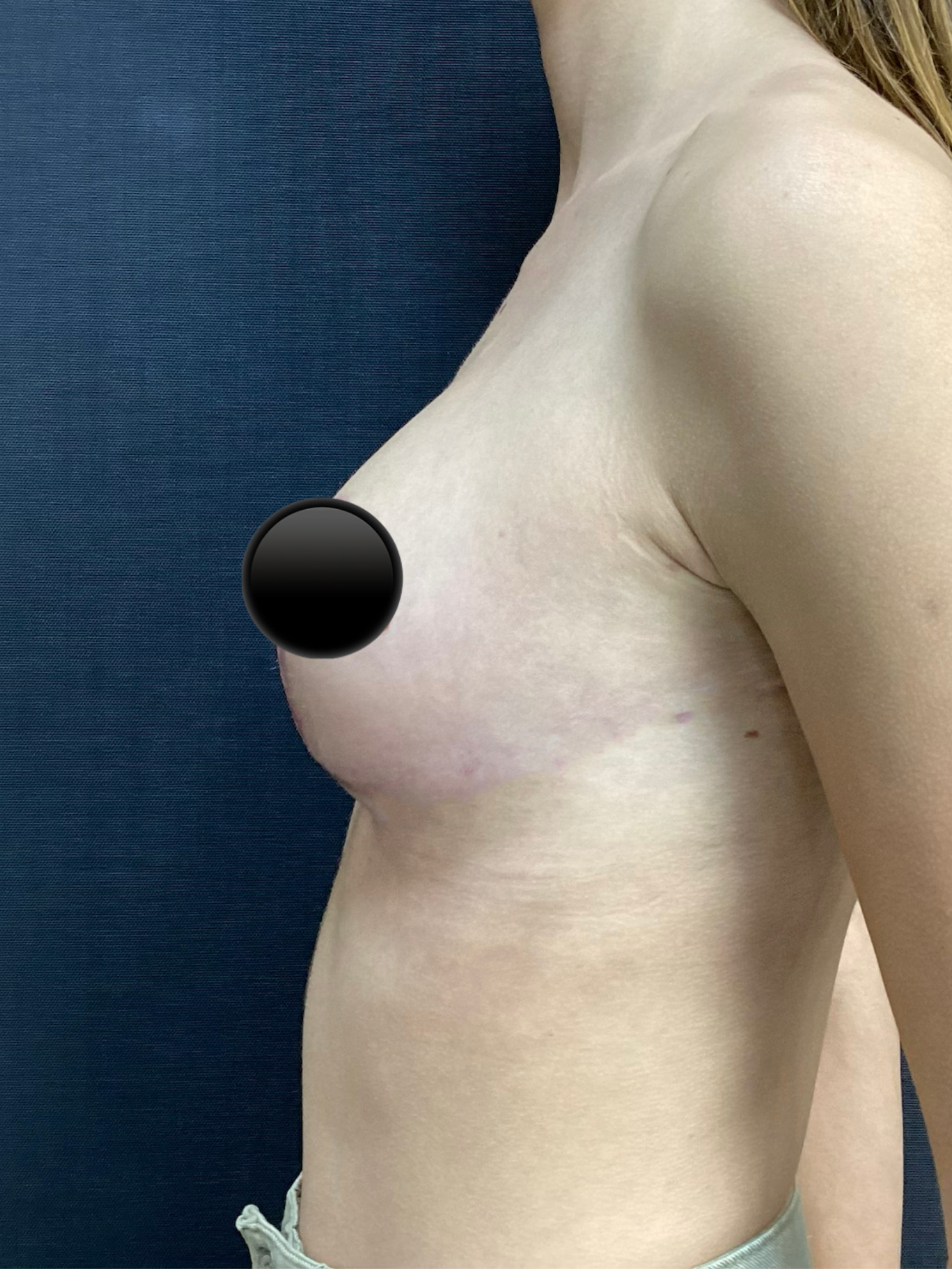 Imagem institucional sobre cirurgia das mamas