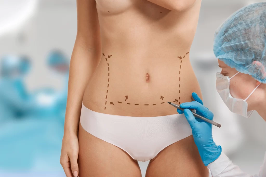 Lipoaspiração
