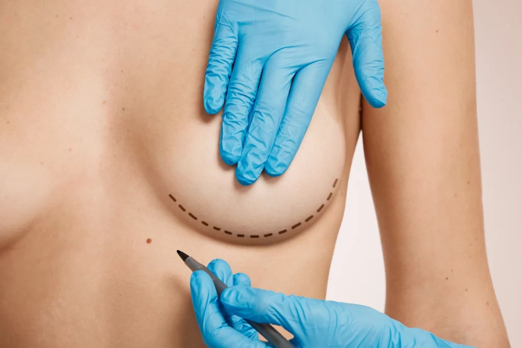 Mamoplastia