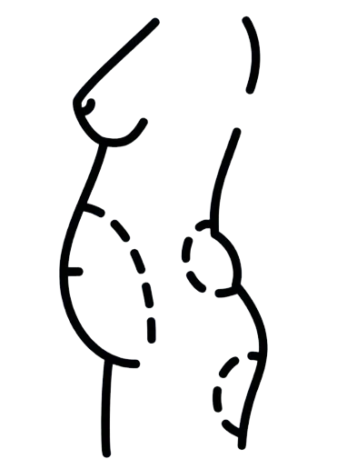 Abdominoplastia