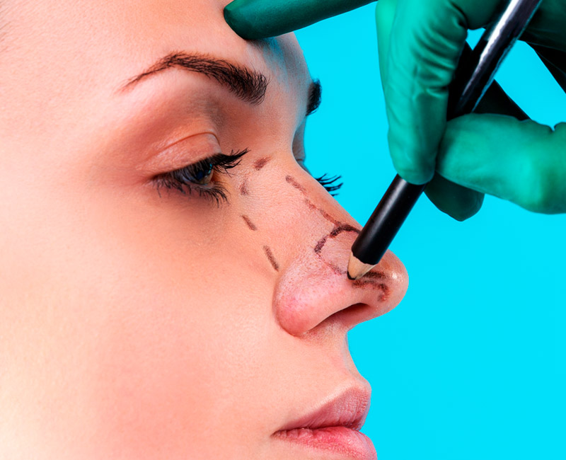 Rinoplastia