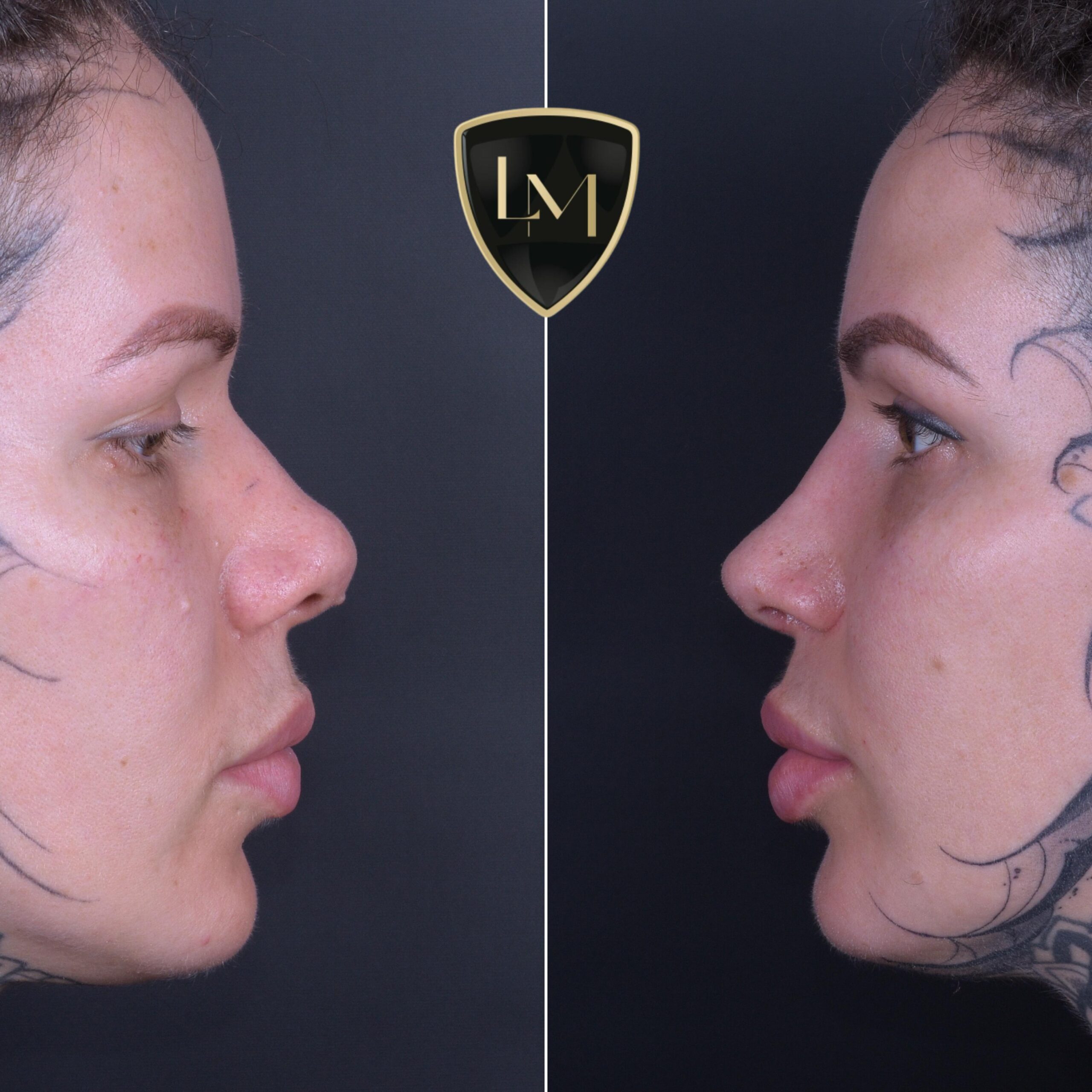 Imagem institucional de rinoplastia