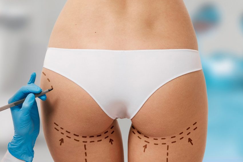 Gluteoplastia