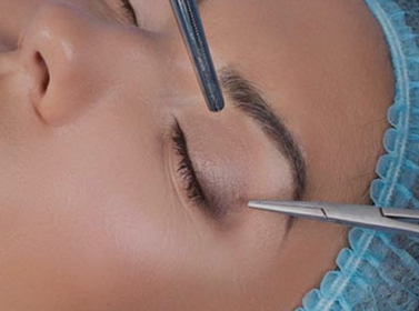 Blefaroplastia